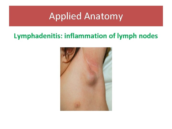 Applied Anatomy Lymphadenitis: inflammation of lymph nodes 