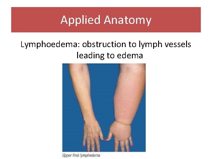 Applied Anatomy Lymphoedema: obstruction to lymph vessels leading to edema 