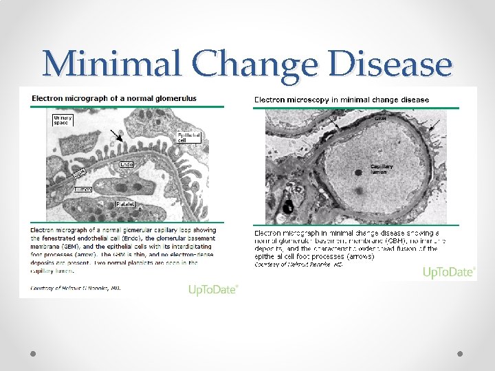 Minimal Change Disease 