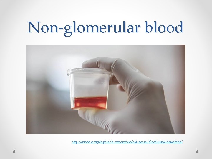 Non-glomerular blood https: //www. everydayhealth. com/urine/what-causes-blood-urine-hematuria/ 