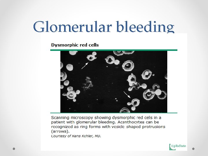 Glomerular bleeding 