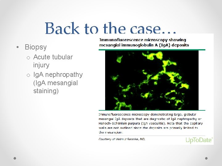 Back to the case… • Biopsy o Acute tubular injury o Ig. A nephropathy