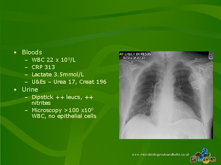  • Bloods – – WBC 22 x 109/L CRP 313 Lactate 3. 5