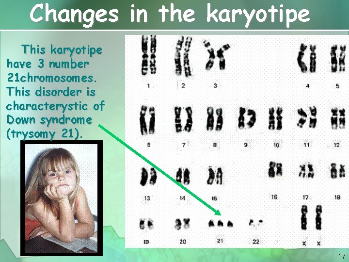Changes in the karyotipe This karyotipe have 3 number 21 chromosomes. This disorder is