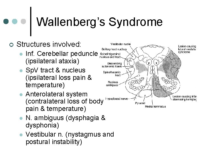 Wallenberg’s Syndrome ¢ Structures involved: l l l Inf. Cerebellar peduncle (ipsilateral ataxia) Sp.