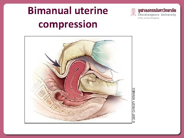 Bimanual uterine compression 