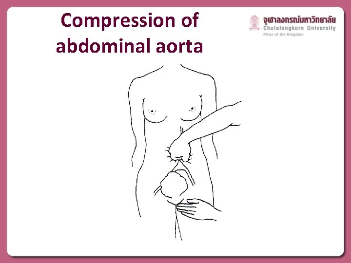 Compression of abdominal aorta 