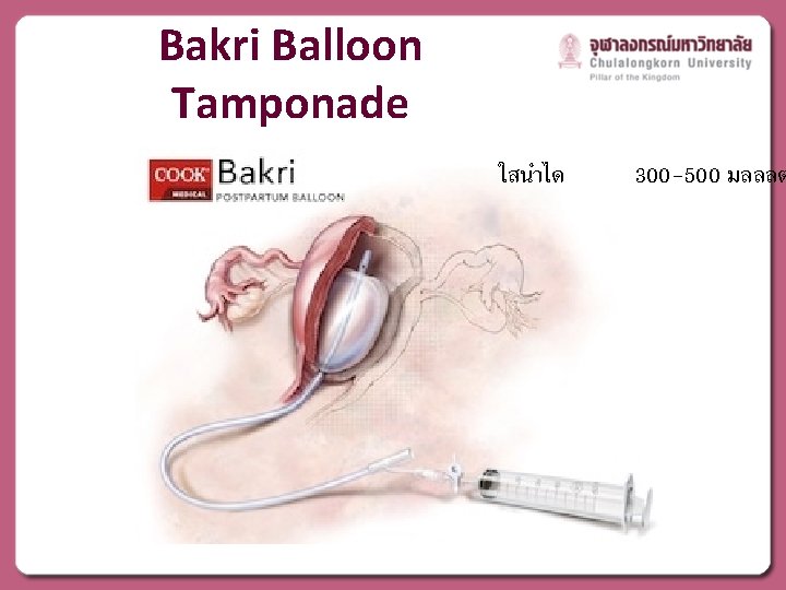 Bakri Balloon Tamponade ใสนำได 300 -500 มลลลต 