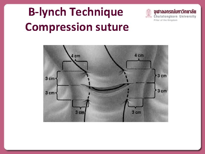 B-lynch Technique Compression suture 