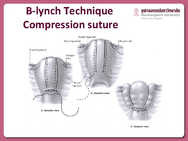 B-lynch Technique Compression suture 