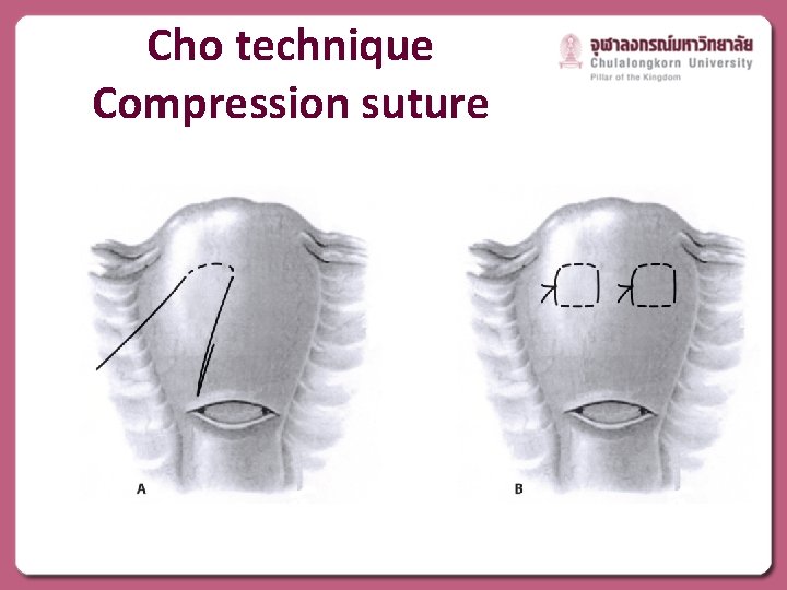 Cho technique Compression suture 