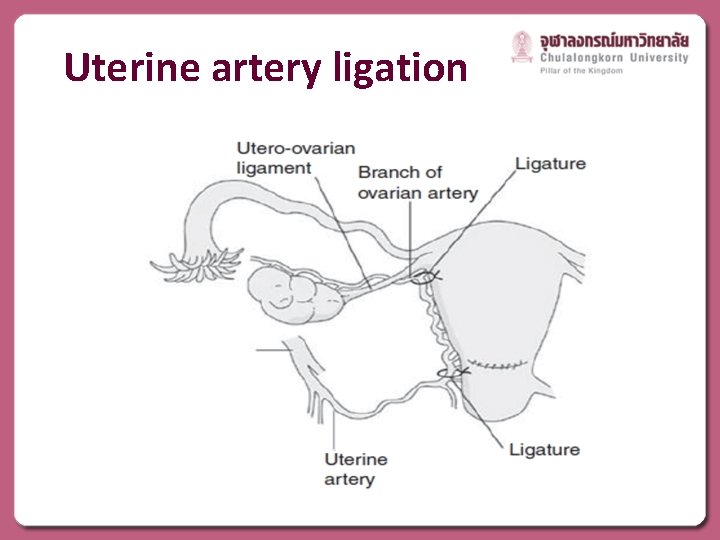 Uterine artery ligation 