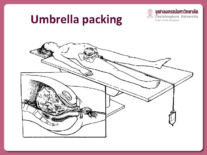 Umbrella packing 