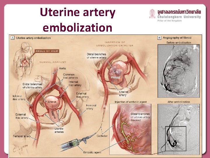 Uterine artery embolization 