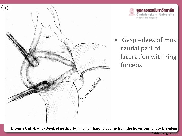  • Gasp edges of most caudal part of laceration with ring forceps B-Lynch