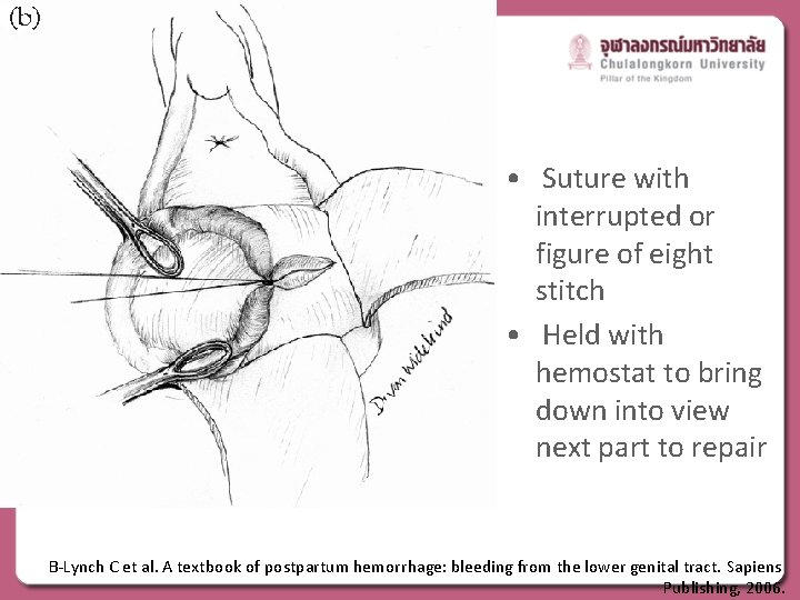  • Suture with interrupted or figure of eight stitch • Held with hemostat