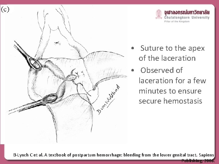  • Suture to the apex of the laceration • Observed of laceration for