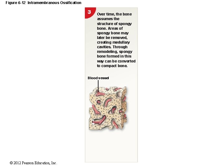 Figure 6 -12 Intramembranous Ossification Over time, the bone assumes the structure of spongy