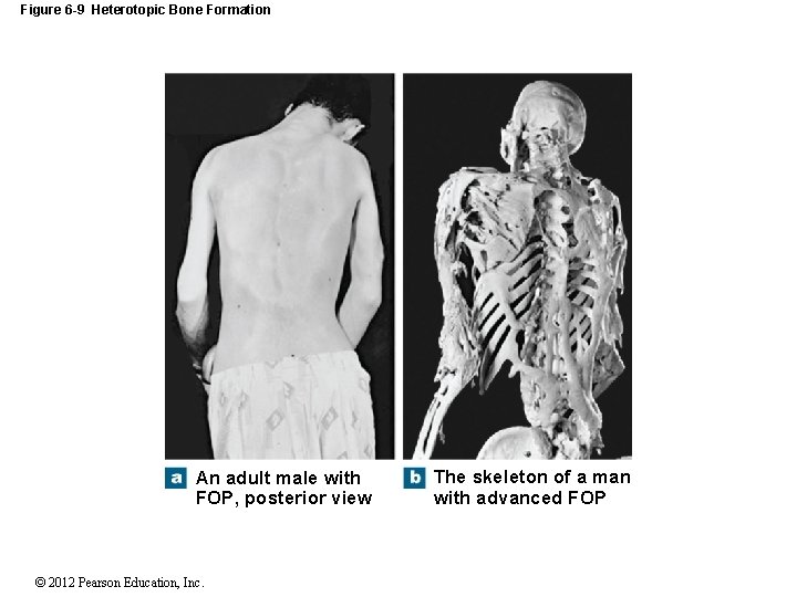 Figure 6 -9 Heterotopic Bone Formation An adult male with FOP, posterior view ©