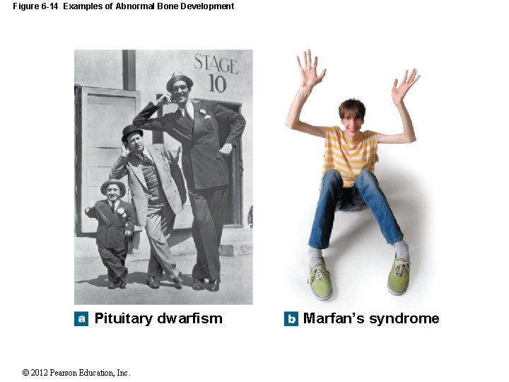 Figure 6 -14 Examples of Abnormal Bone Development Pituitary dwarfism © 2012 Pearson Education,