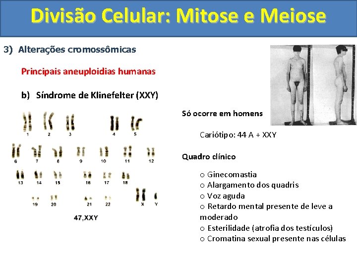 Divisão Celular: Mitose e Meiose 3) Alterações cromossômicas Principais aneuploidias humanas b) Síndrome de