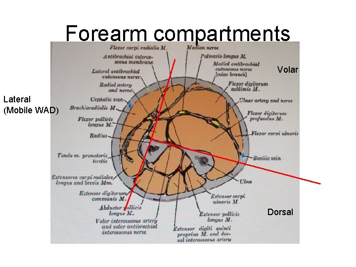 Forearm compartments Volar Lateral (Mobile WAD) Dorsal 