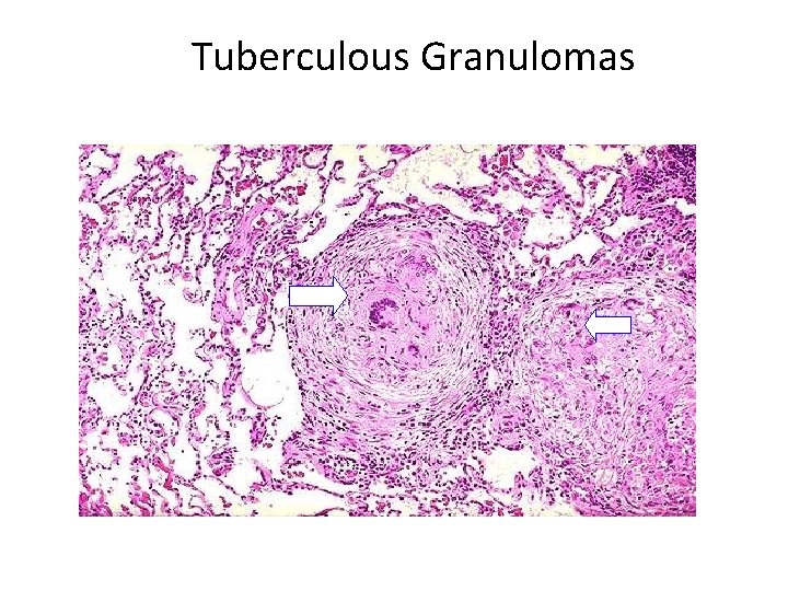 Tuberculous Granulomas 