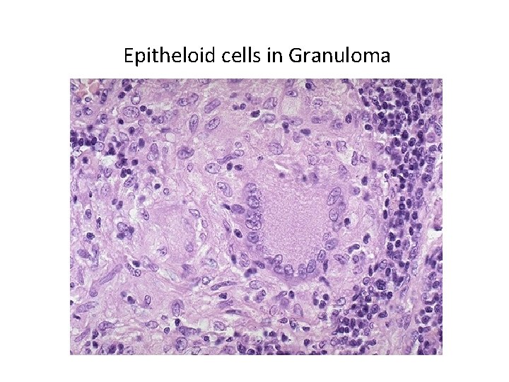 Epitheloid cells in Granuloma 