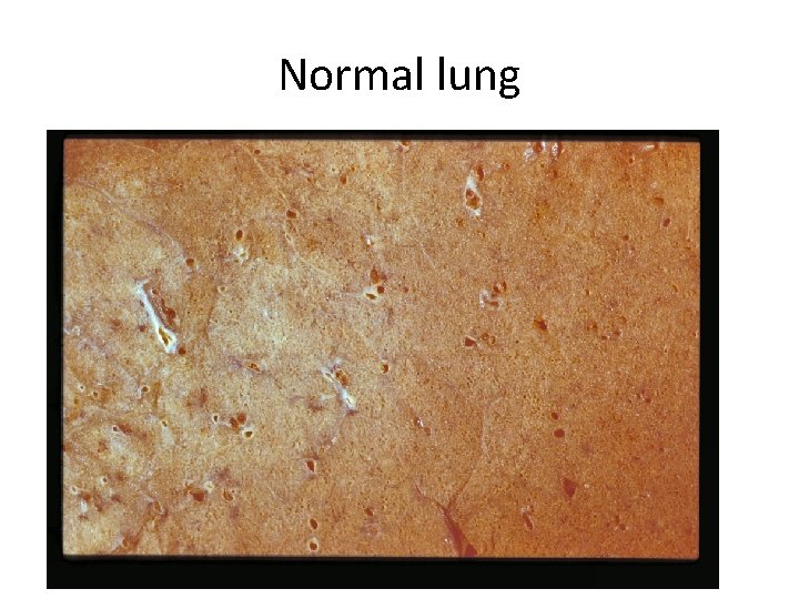 Normal lung 