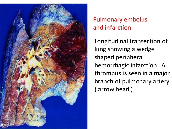 Pulmonary embolus and infarction Longitudinal transection of lung showing a wedge shaped peripheral hemorrhagic