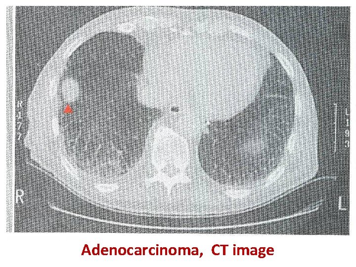 Adenocarcinoma, CT image 