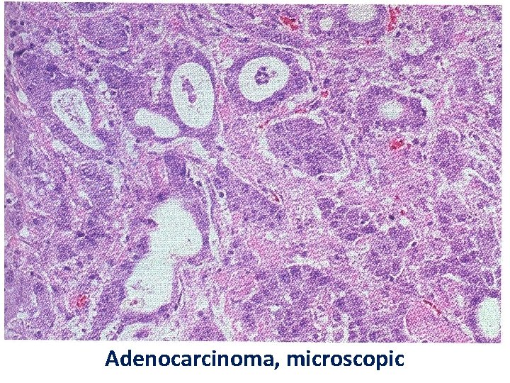 Adenocarcinoma, microscopic 