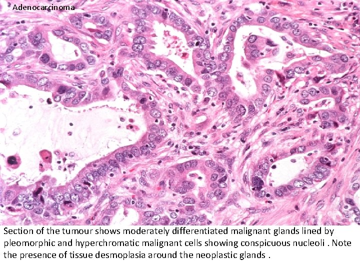 Adenocarcinoma Section of the tumour shows moderately differentiated malignant glands lined by pleomorphic and