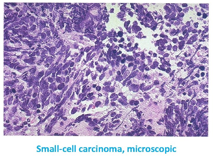 Small-cell carcinoma, microscopic 