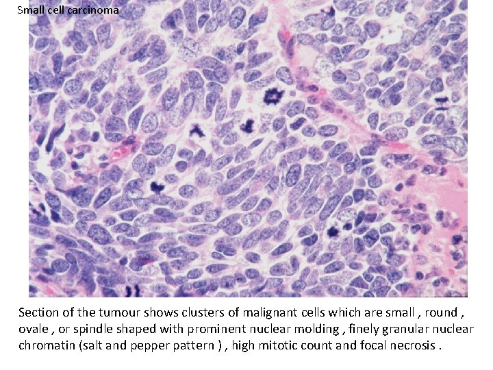 Small cell carcinoma Section of the tumour shows clusters of malignant cells which are