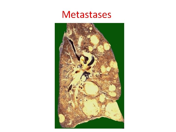 Metastases 