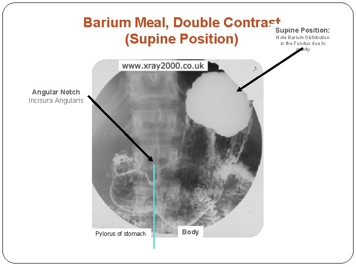 Barium Meal, Double Contrast. Supine Position: (Supine Position) Note Barium Distribution in the Fundus