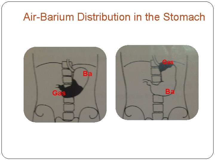 Air-Barium Distribution in the Stomach Gas Ba 