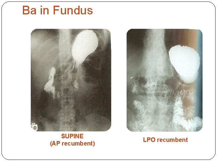 Ba in Fundus SUPINE (AP recumbent) LPO recumbent 