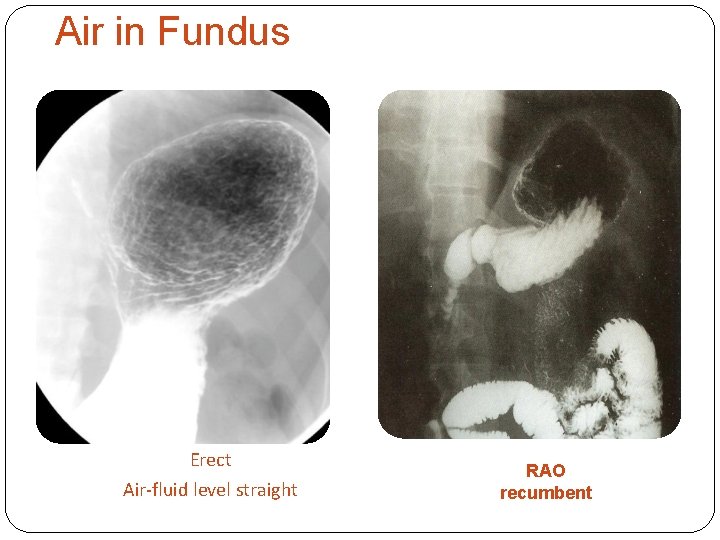 Air in Fundus Erect Air-fluid level straight RAO recumbent 