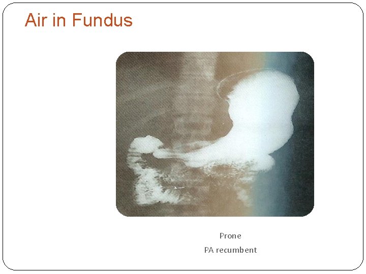 Air in Fundus Prone PA recumbent 