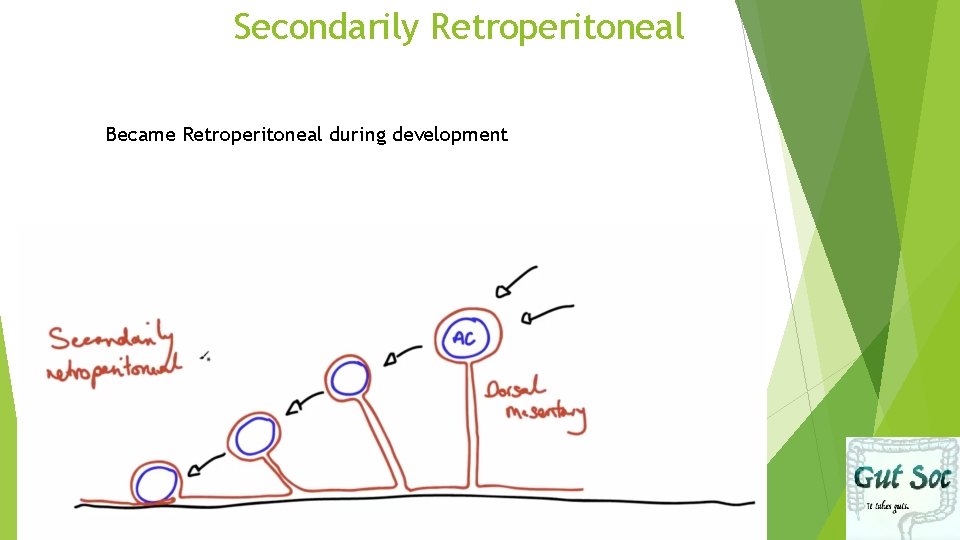 Secondarily Retroperitoneal Became Retroperitoneal during development 