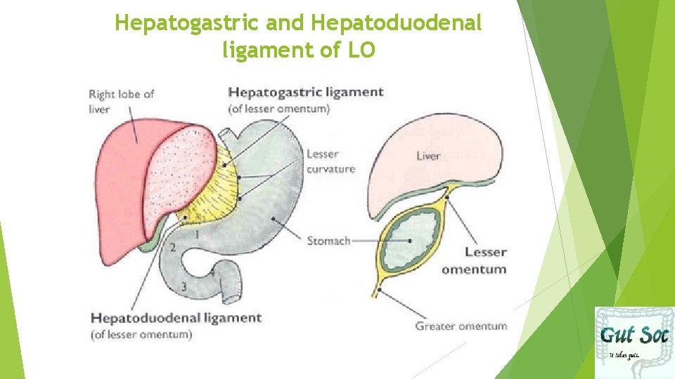 Hepatogastric and Hepatoduodenal ligament of LO 