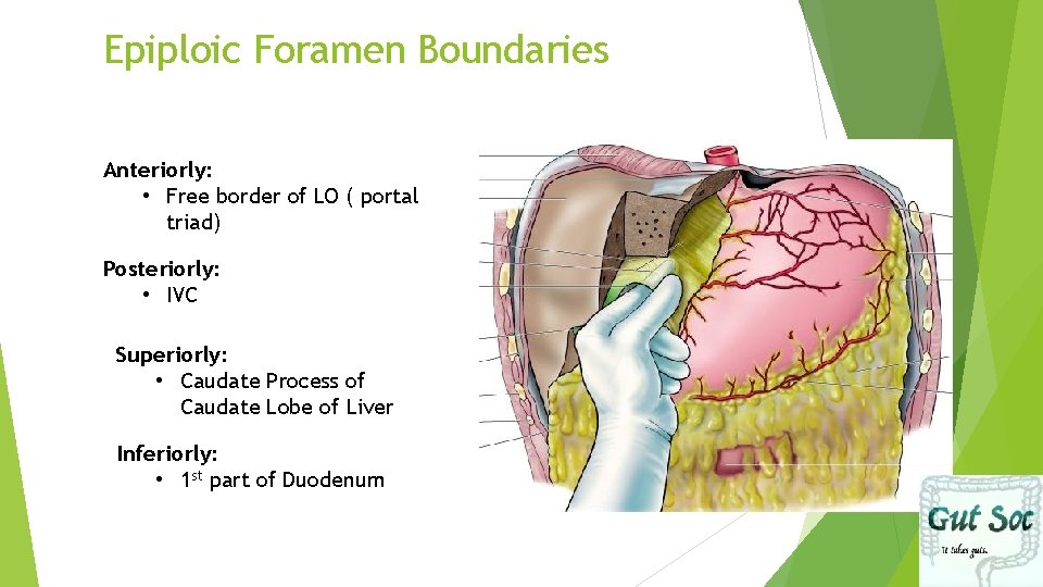 Epiploic Foramen Boundaries Anteriorly: • Free border of LO ( portal triad) Posteriorly: •