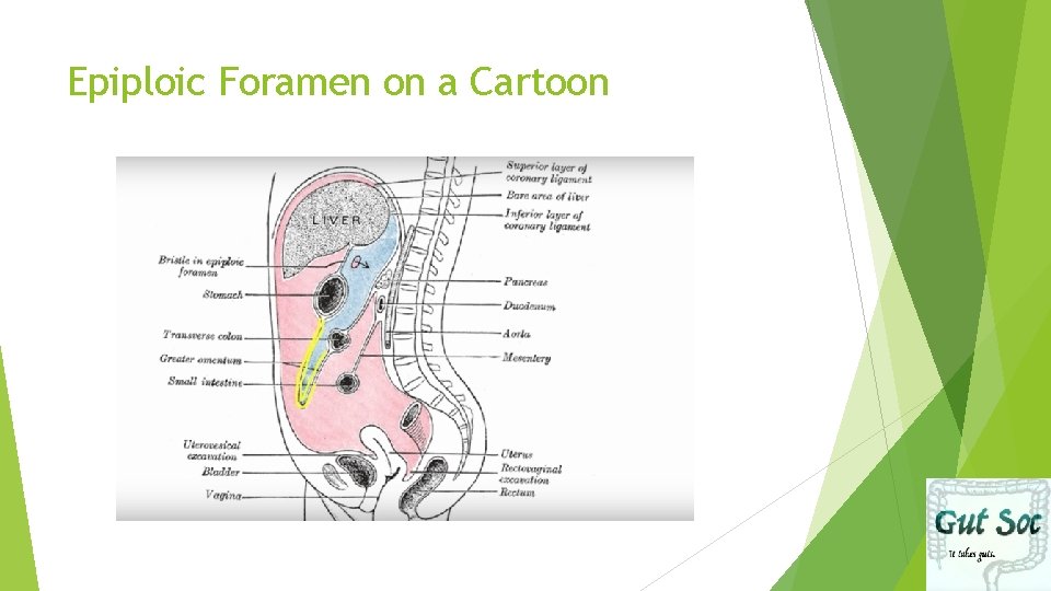 Epiploic Foramen on a Cartoon 
