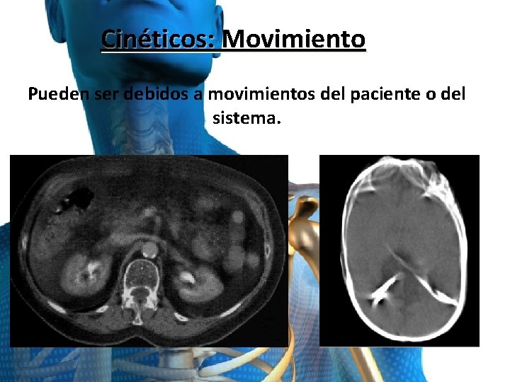 Cinéticos: Movimiento Pueden ser debidos a movimientos del paciente o del sistema. 