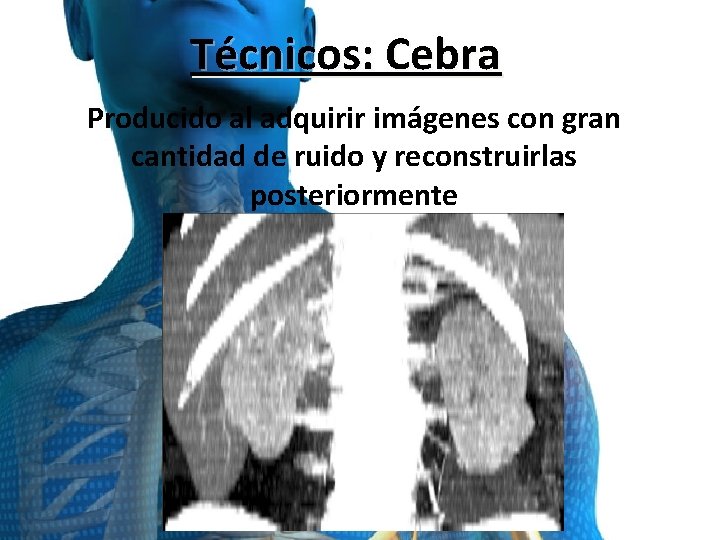 Técnicos: Cebra Producido al adquirir imágenes con gran cantidad de ruido y reconstruirlas posteriormente