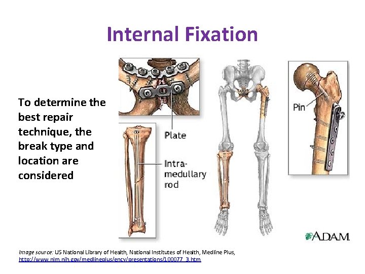 Internal Fixation To determine the best repair technique, the break type and location are Internal Fixation To determine the best repair technique, the break type and location are