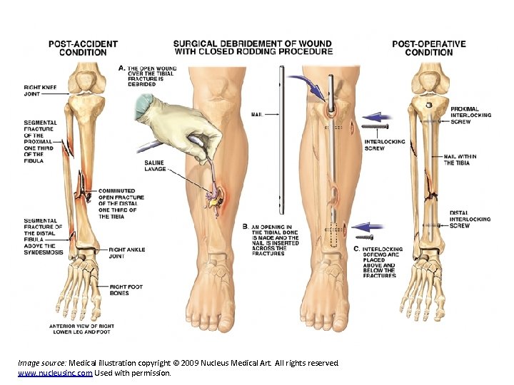 Image source: Medical illustration copyright © 2009 Nucleus Medical Art. All rights reserved. www. Image source: Medical illustration copyright © 2009 Nucleus Medical Art. All rights reserved. www.