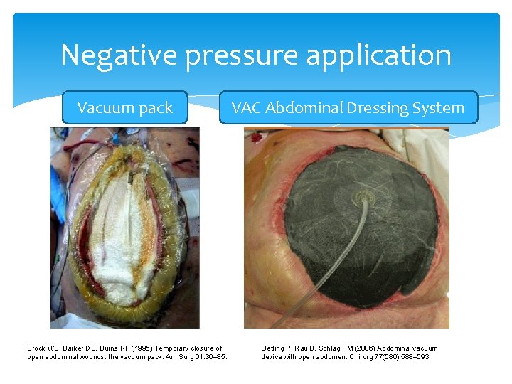 Negative pressure application Vacuum pack Brock WB, Barker DE, Burns RP (1995) Temporary closure Negative pressure application Vacuum pack Brock WB, Barker DE, Burns RP (1995) Temporary closure